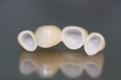 протезирование зубов